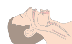 The nasal airway is best inserted when the patient is in the supine position. Lubricate the airway prior to insertion with a water soluble lubricant.